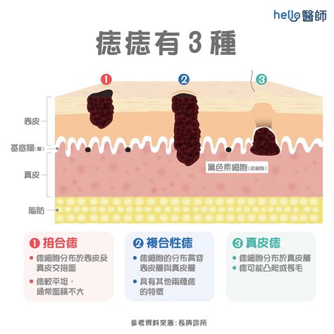 為什麼會長痣|痣形成的原因？痣長毛、痣變多變大是痣病變？5招判。